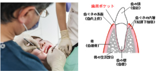 歯周病（歯槽膿漏）の検査